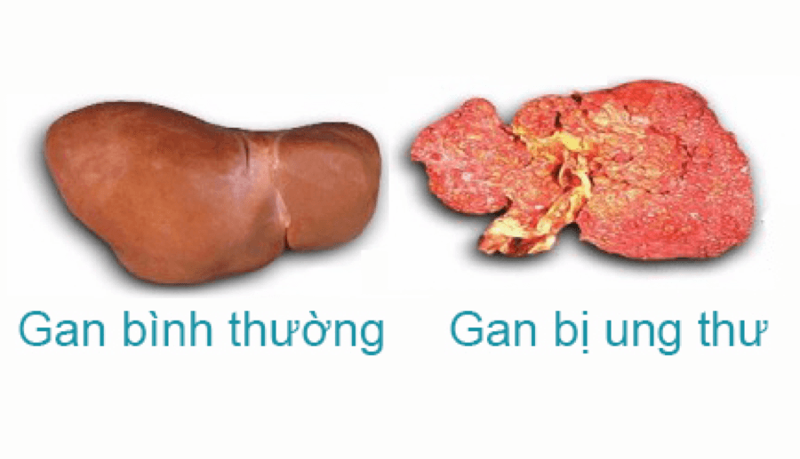 gan bị ung thư